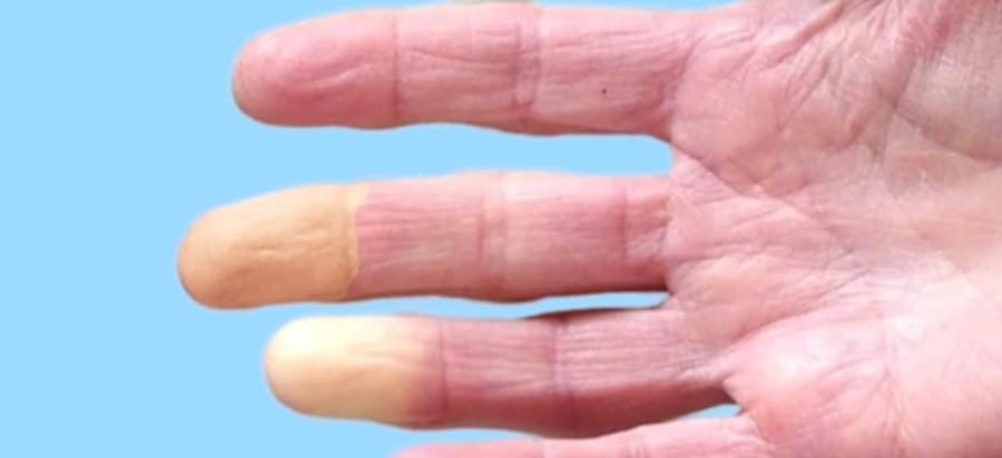 <p>Qué es el Fenómeno Raynaud y cómo detectarlo</p>